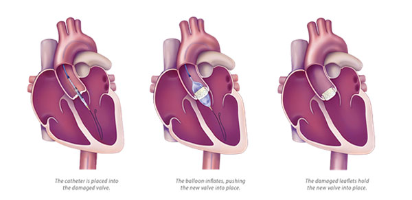 Springfield Heart Surgeons Aortic-Valve-TAVR-Surgery